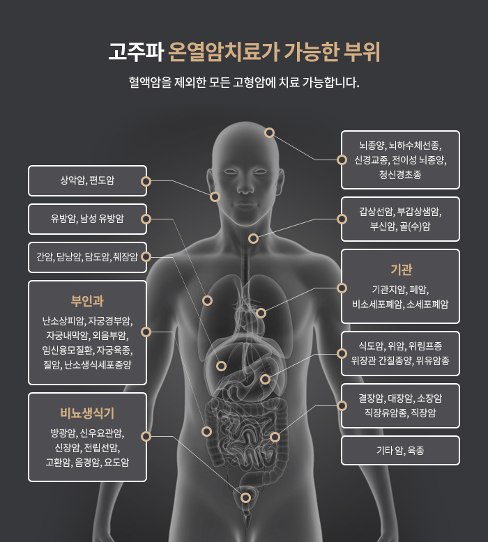 고주파 온열암치료가 가능한 부위